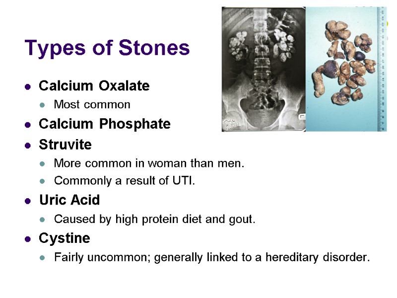Types of Stones Calcium Oxalate  Most common Calcium Phosphate  Struvite  